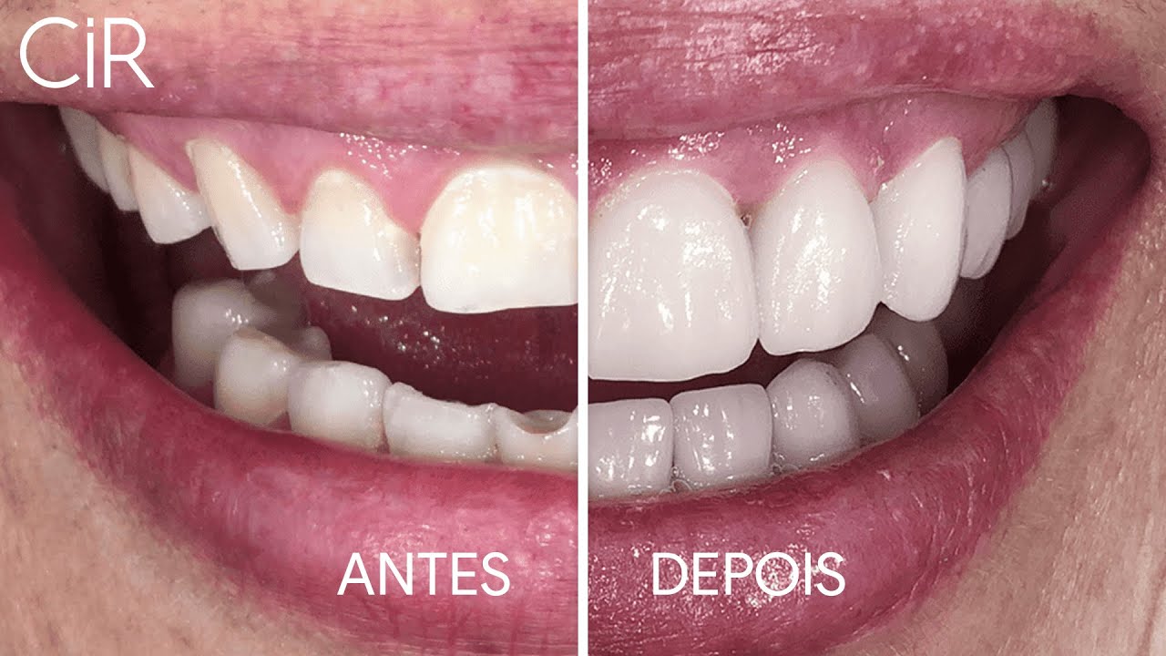 Transformação com Resinas Compostas